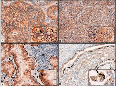 Indoleamine 2,3-Dioxygenase 2 Immunohistochemical Expression in Resected Human Non-small Cell Lung Cancer: A Potential New Prognostic Tool